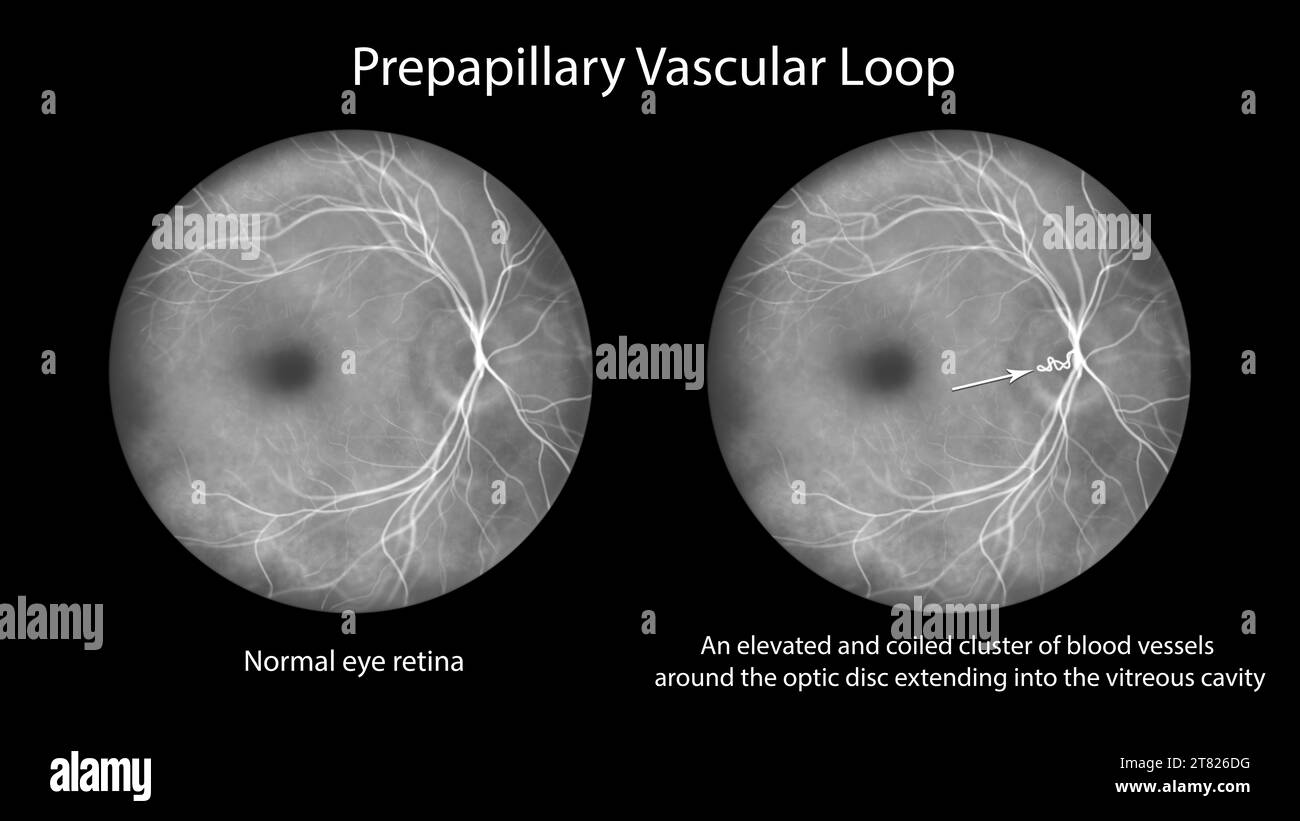 Prepapillary vascular loop on the retina, illustration Stock Photo