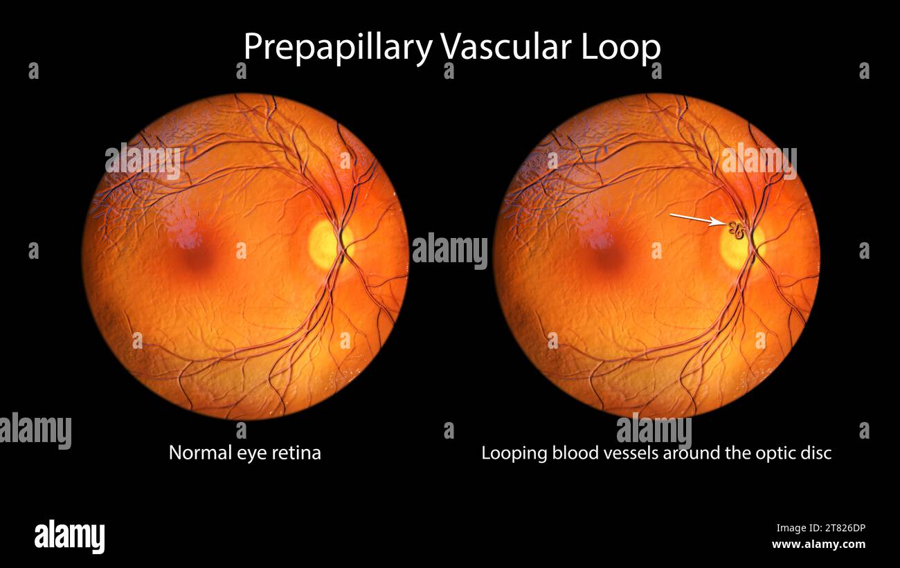 Illustration of a prepapillary vascular loop on the retina, as observed