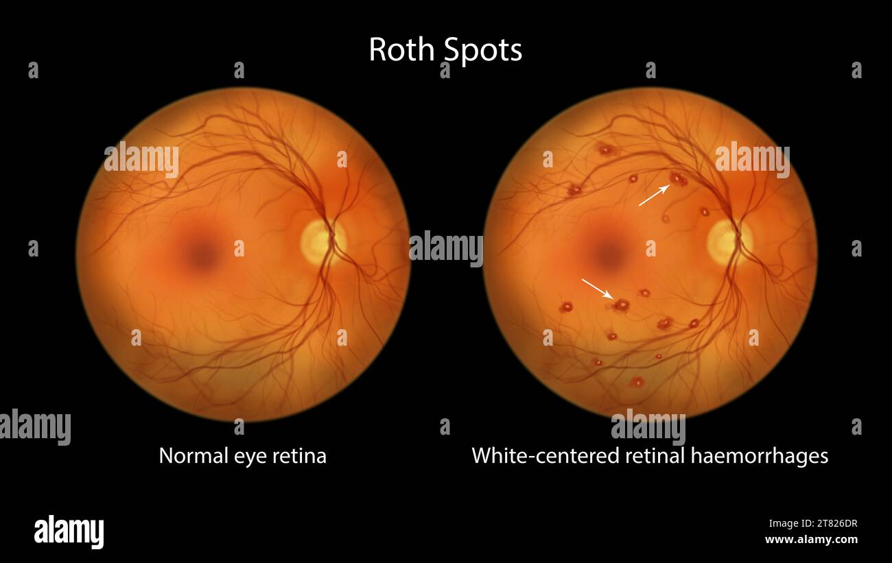 Roth Spots In The Retina Illustration Stock Photo Alamy roth-spots-in-the-retina-illustration-stock-photo-alamy