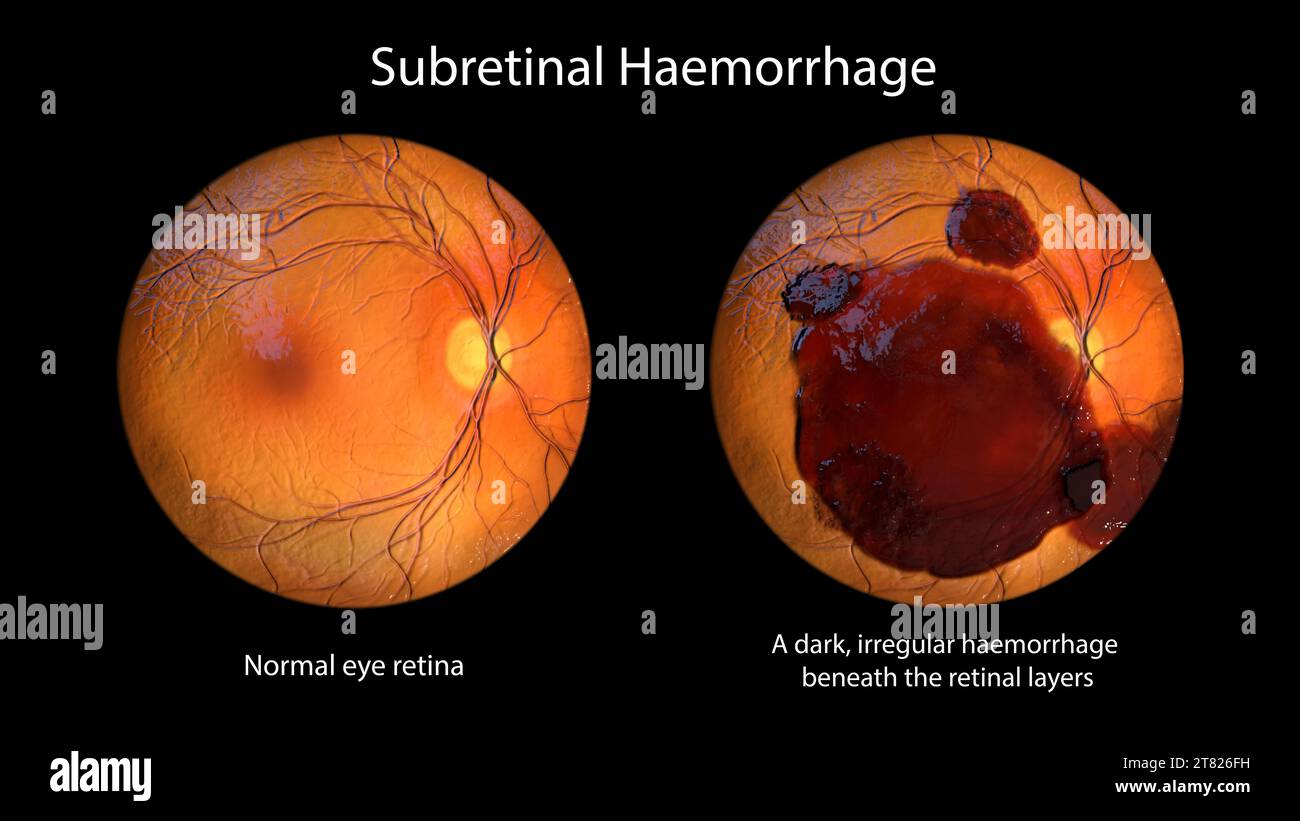 Subretinal haemorrhage on the retina, illustration Stock Photo Alamy