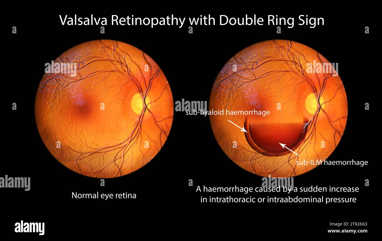 Valsava retinopathy, illustration Stock Photo