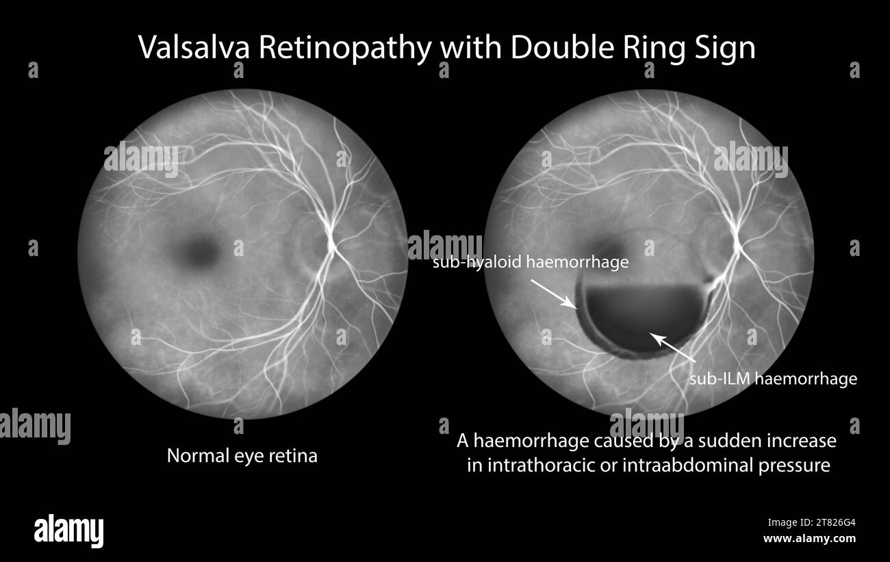 Valsava retinopathy, illustration Stock Photo