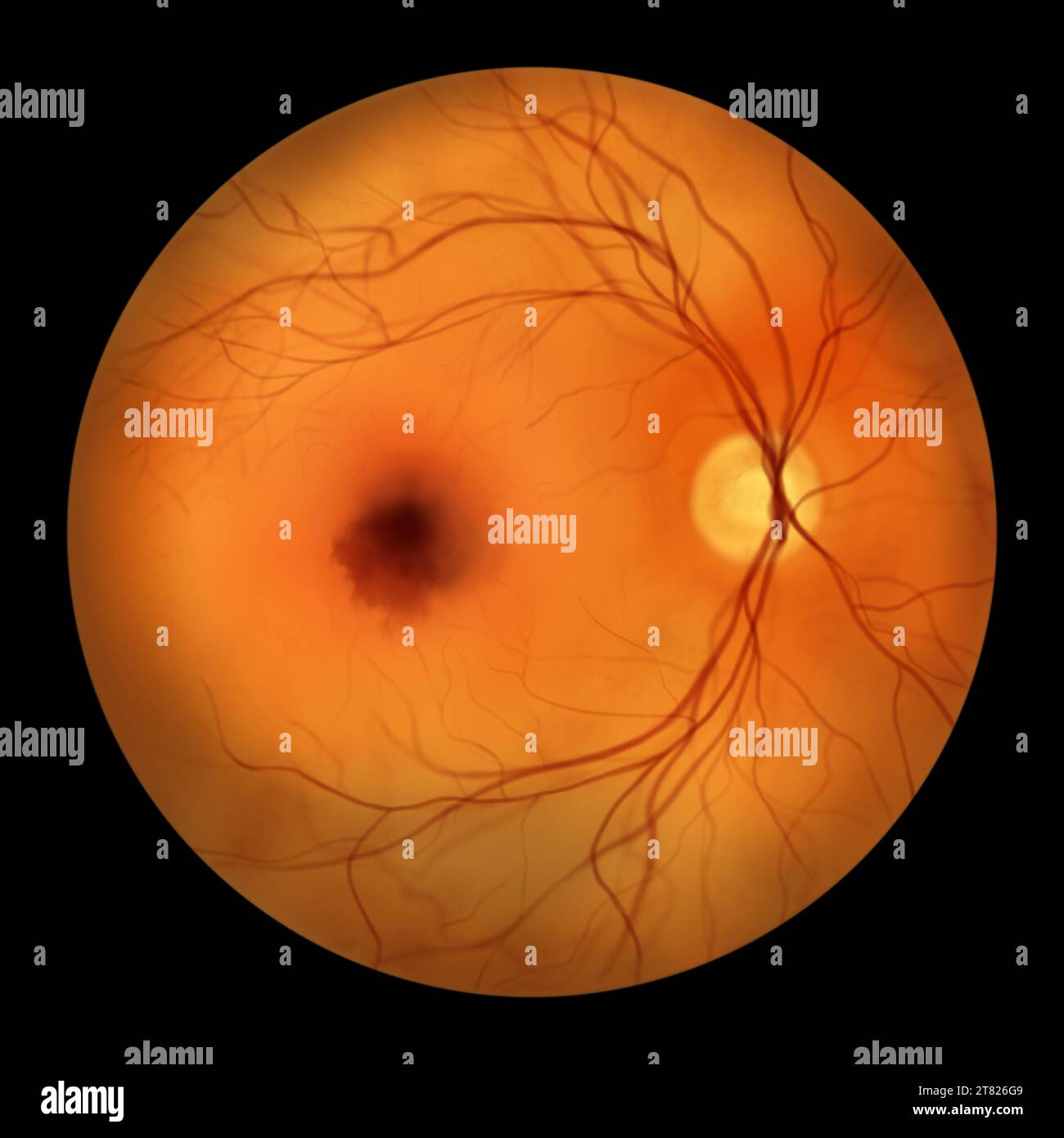 Illustration of a submacular haemorrhage observed during ophthalmoscopy