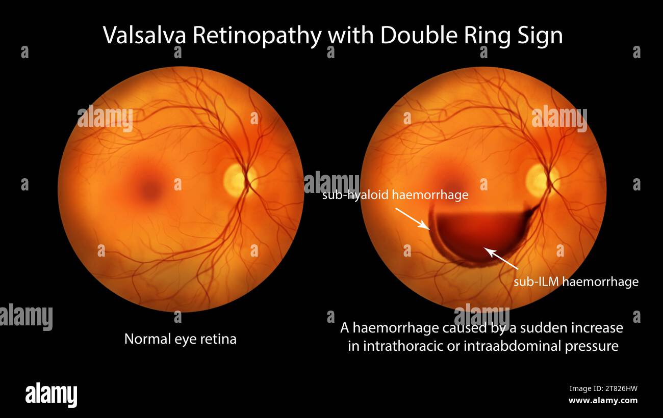 Valsava retinopathy, illustration Stock Photo