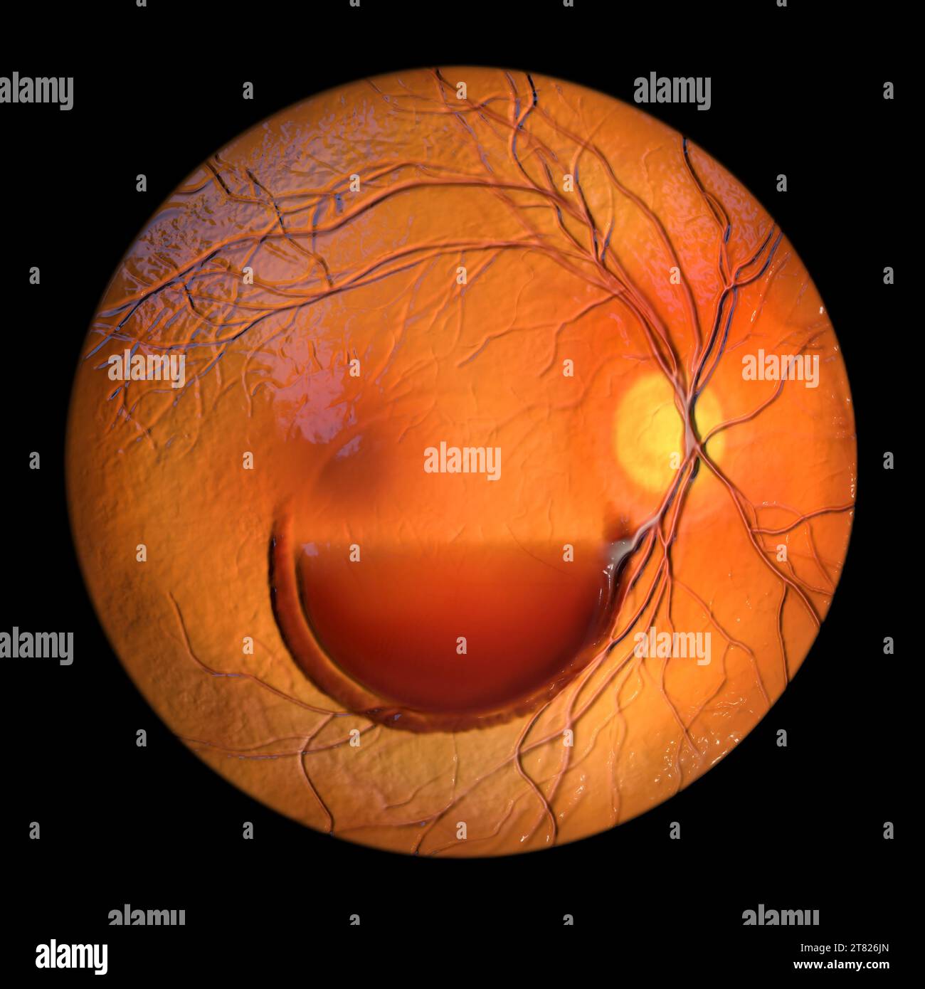 Valsava retinopathy, illustration Stock Photo