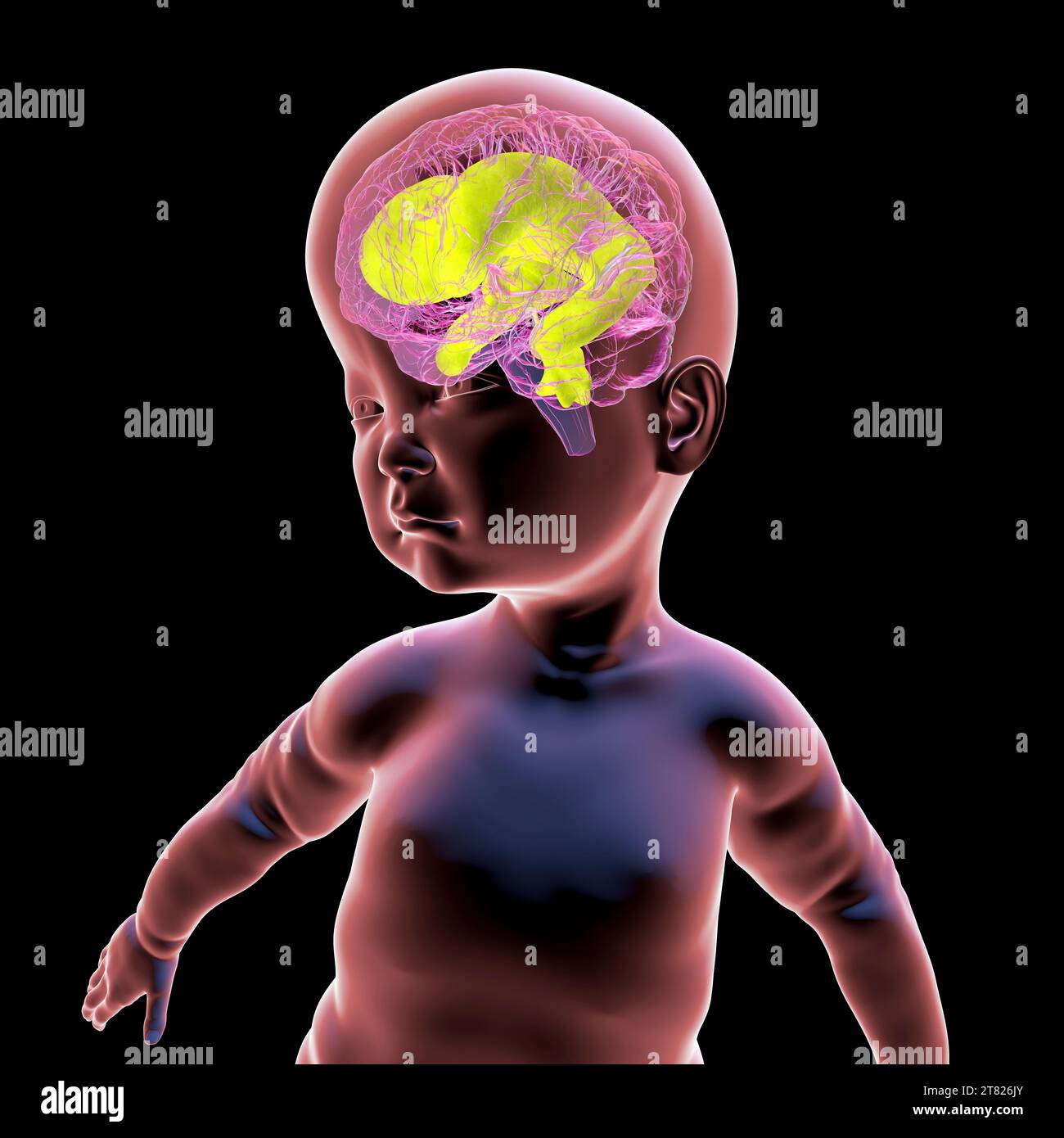 Computer illustration of a baby with macrocephaly and enlarged brain ventricles, a condition