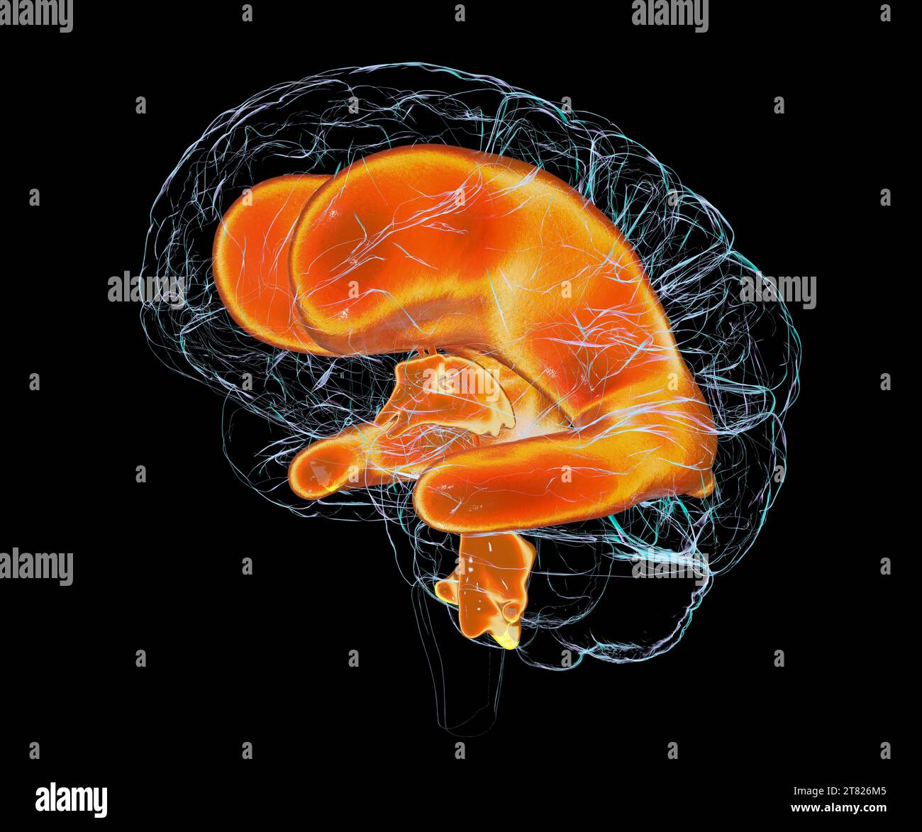 Enlarged ventricles of a child's brain, illustration Stock Photo