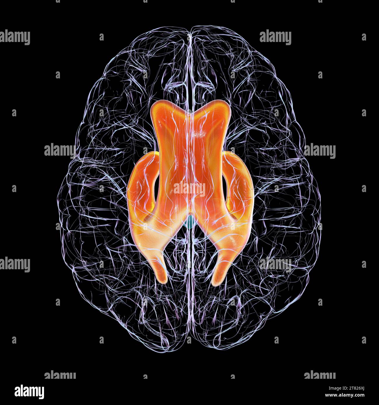 Enlarged lateral ventricles of the brain, illustration Stock Photo