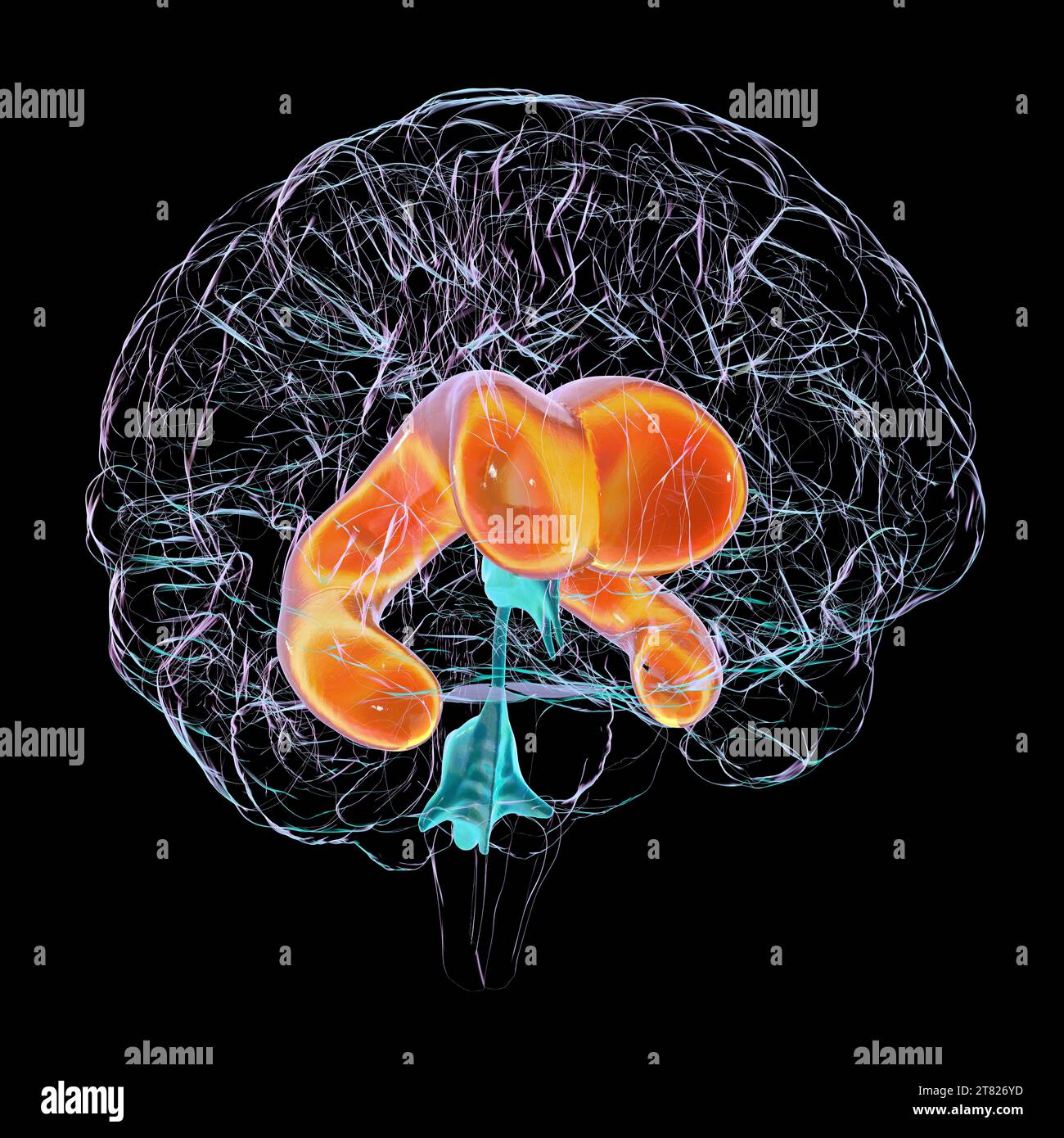 Enlarged lateral ventricles of the brain, illustration Stock Photo