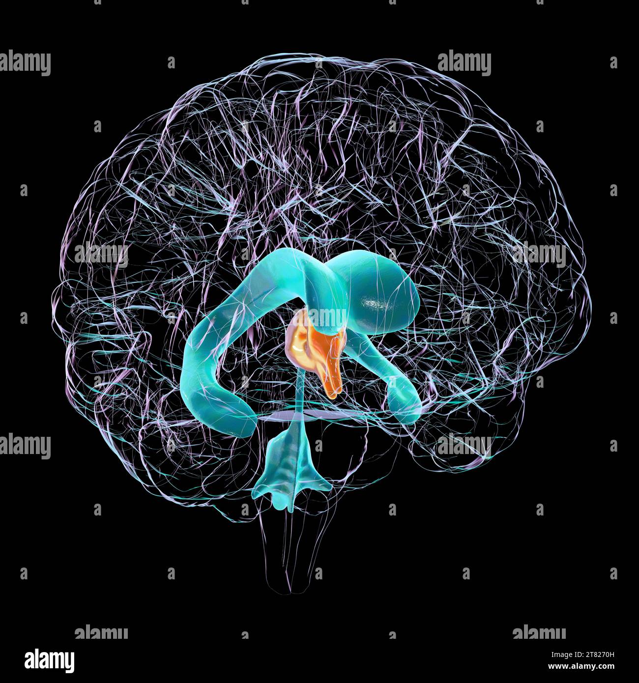 Enlarged third ventricle of the brain, illustration Stock Photo Alamy