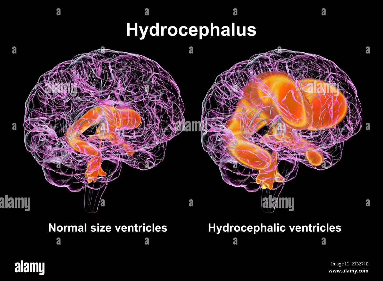 Enlarged and normal brain ventricles, illustration Stock Photo Alamy