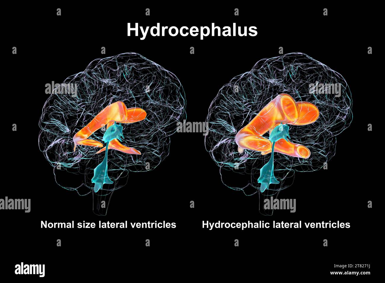 Enlarged and normal brain lateral ventricles, illustration Stock Photo Alamy