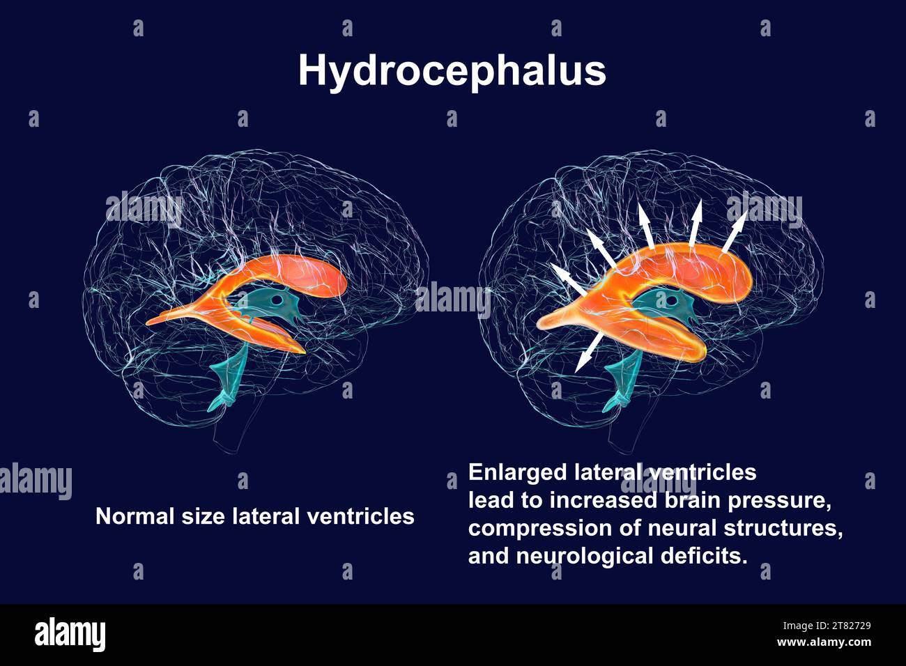 Enlarged and normal brain lateral ventricles, illustration Stock Photo Alamy