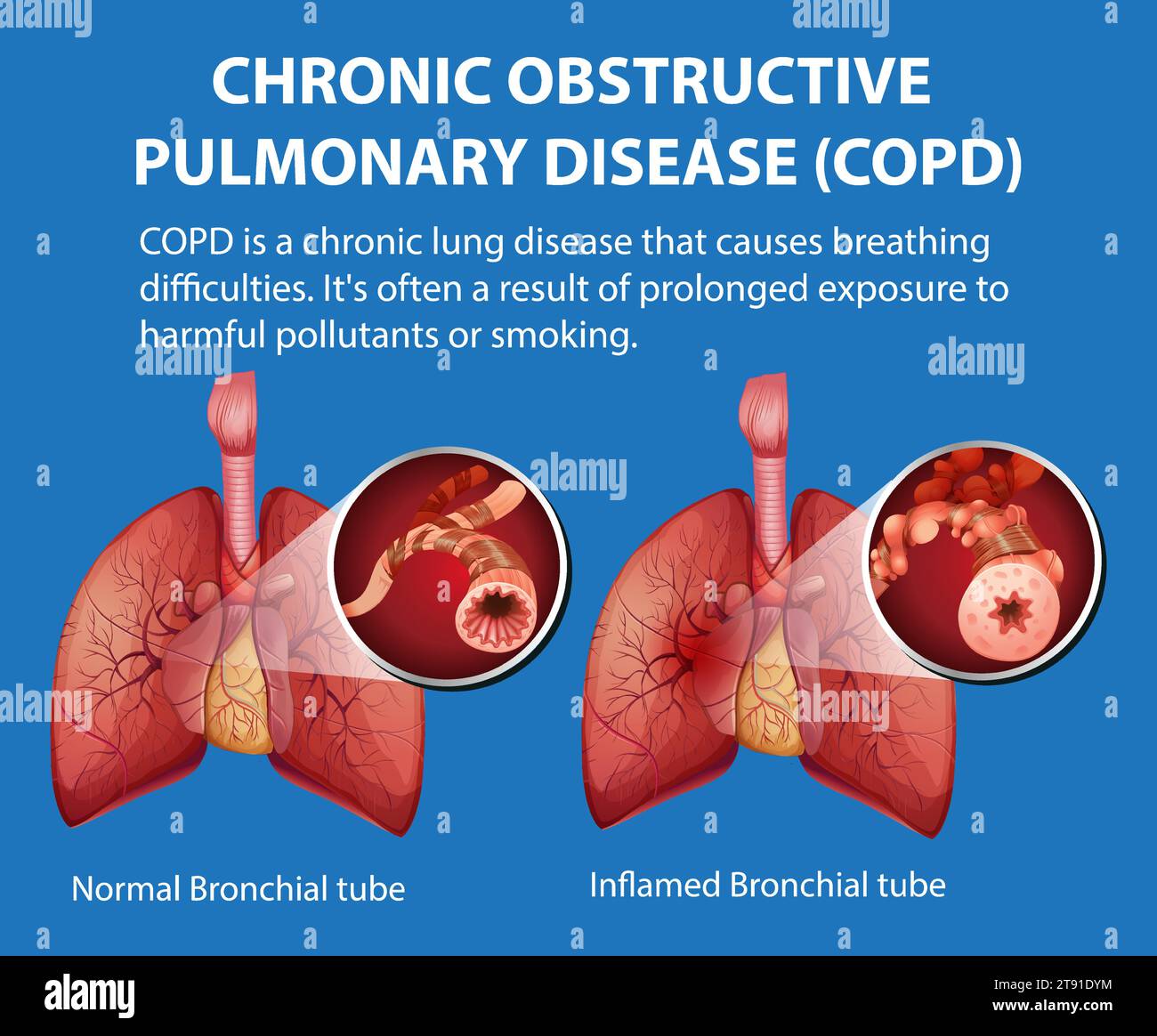 Illustrated infographic explaining chronic obstructive pulmonary ...