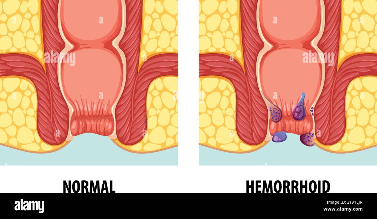 Illustration comparing normal anatomy with hemorrhoids in humans Stock Vector