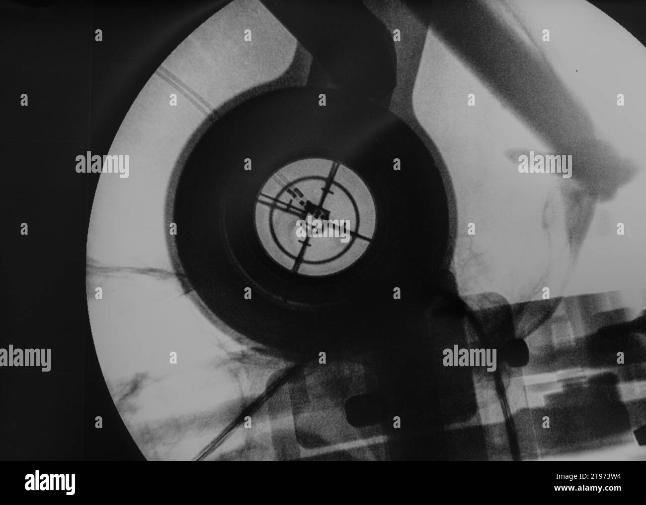 Intraoperative fluoroscopy of electrodes at the target in deep brain stimulation surgery for
