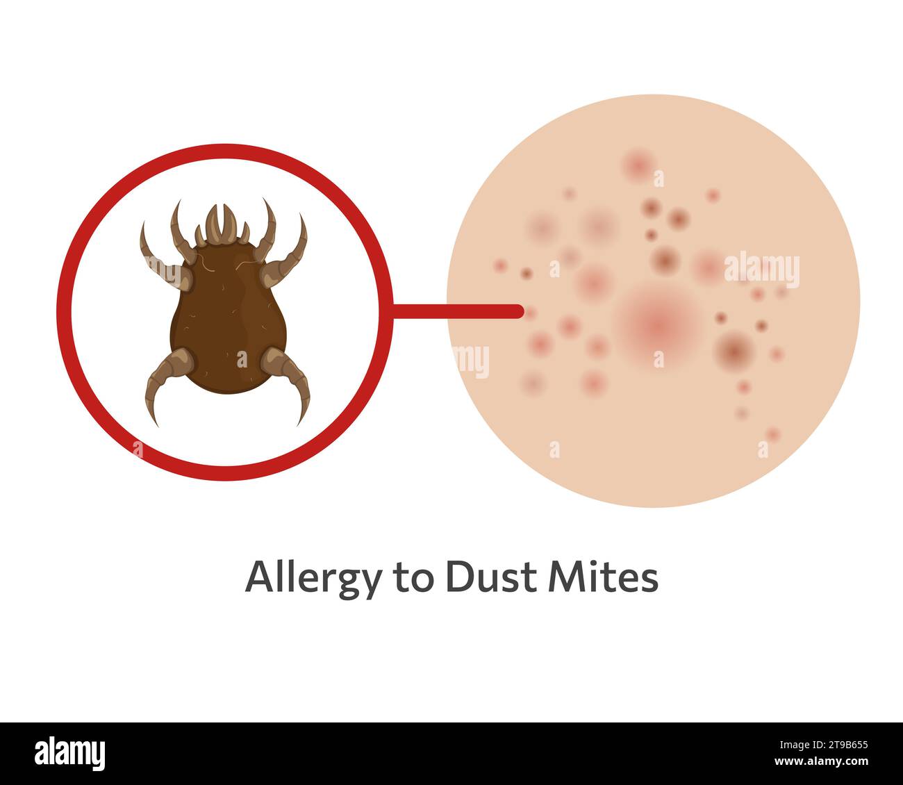 Skin allergy to dust mites vector illustration design Stock Vector