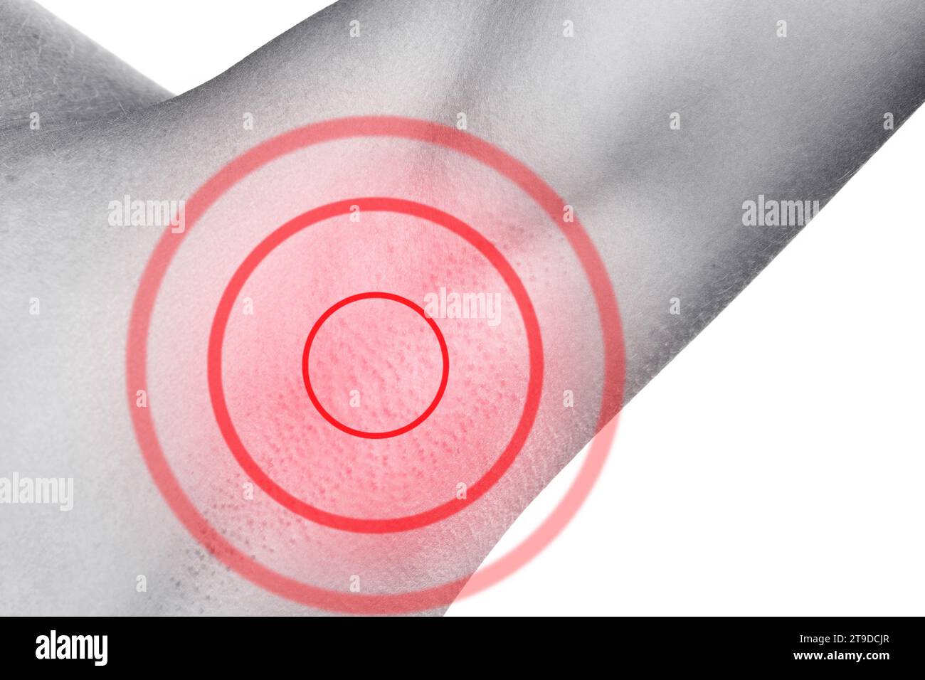 Closeup of female armpit with redness. Skin irritation or swollen lymph node. Stock Photo