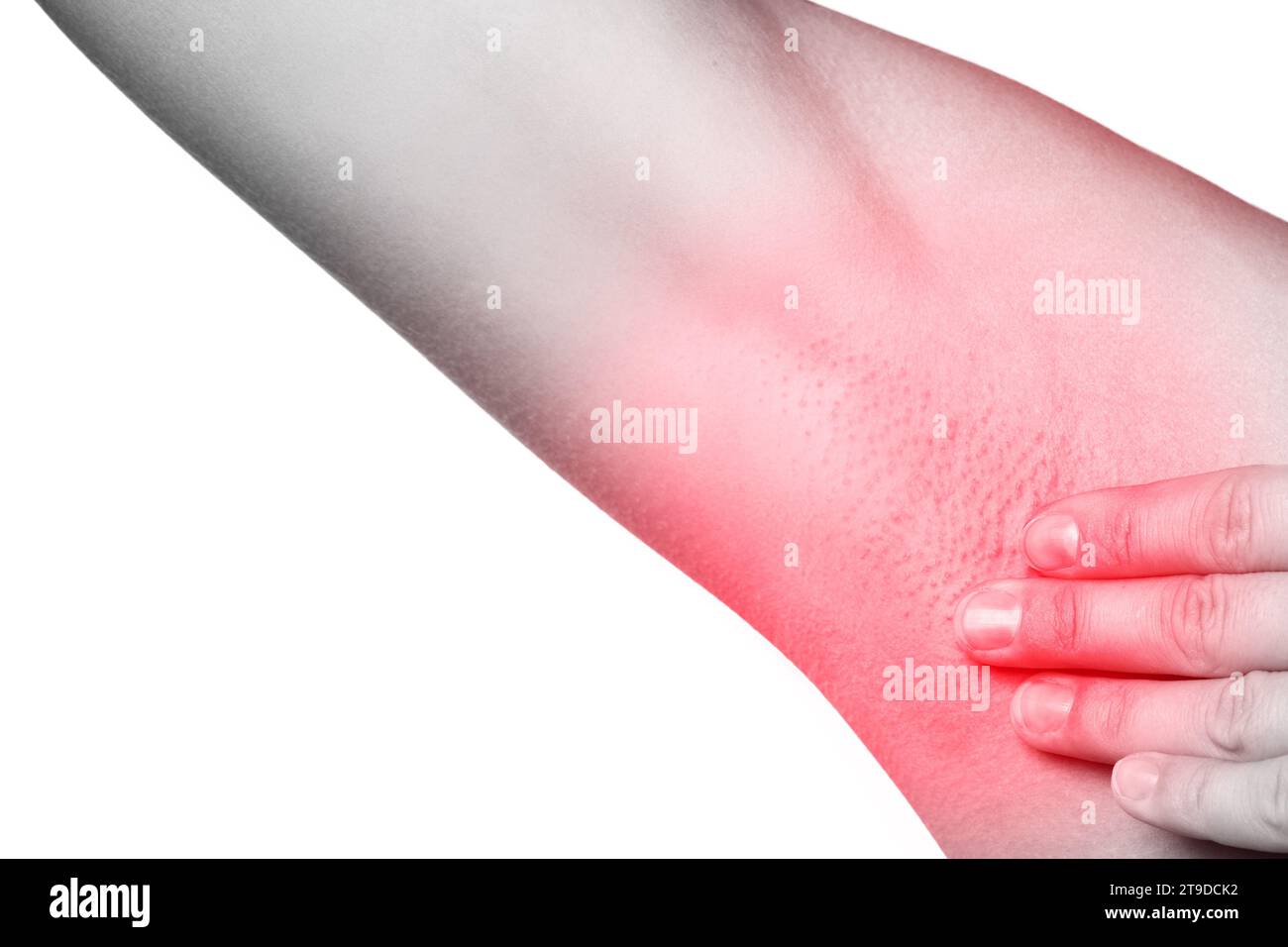 Closeup Of Female Armpit With Redness Skin Irritation Or Swollen Lymph