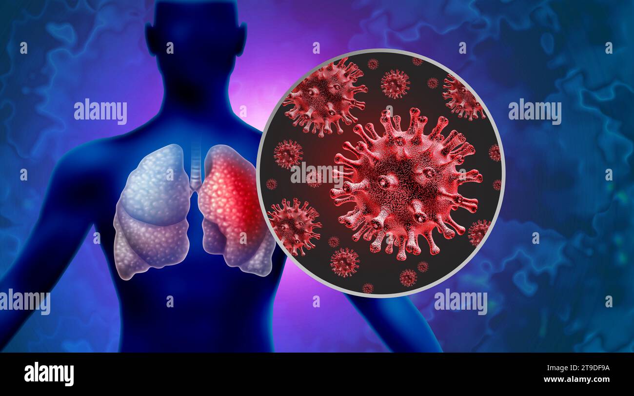 Pneumonia Outbreak Virus pathogen Lung Infection and Human lung infections or respiratory inflammation disease as influenza flu outbreak or pulmonary Stock Photo