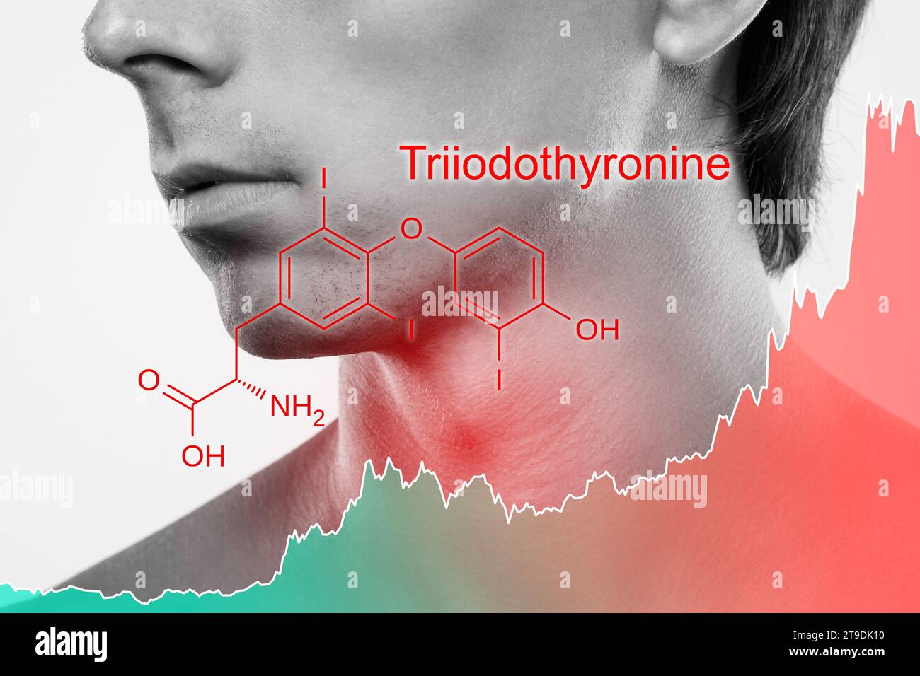 Male neck and chart of rising triiodothyronine hormone produced by thyroid Stock Photo