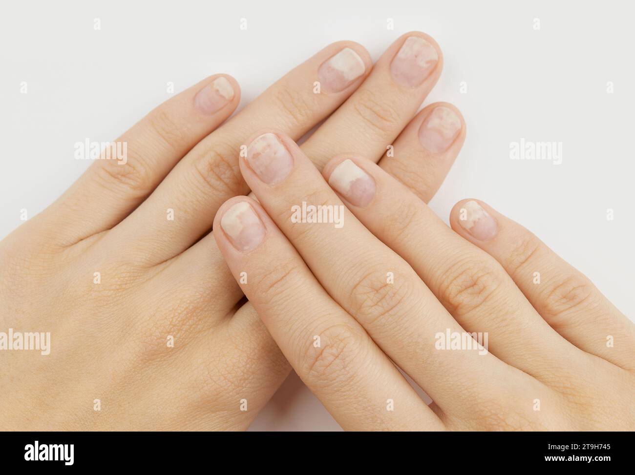 Fingernails with onycholysis after removing gel polish on grey background. Womans hands with damaged nails Stock Photo