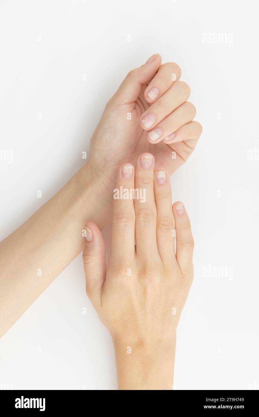 Fingernails with onycholysis after removing gel polish on white background. Womans hands with damaged nails Stock Photo
