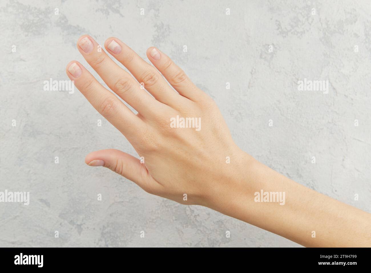Fingernails with onycholysis after removing gel polish on grey background. Womans hand with damaged nails Stock Photo
