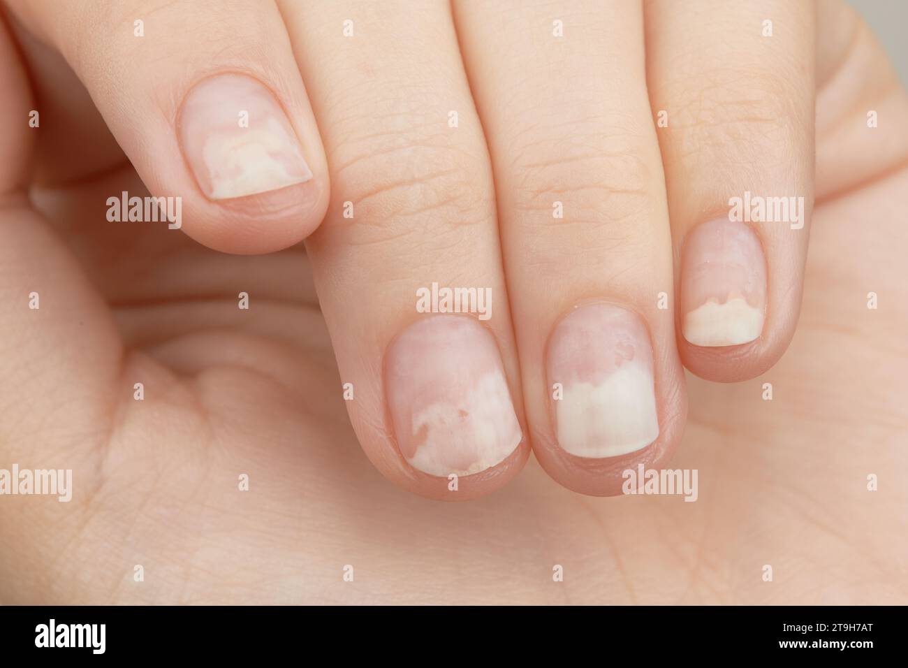 Fingernails with onycholysis after removing gel polish. Womans hands with damaged nails Stock Photo