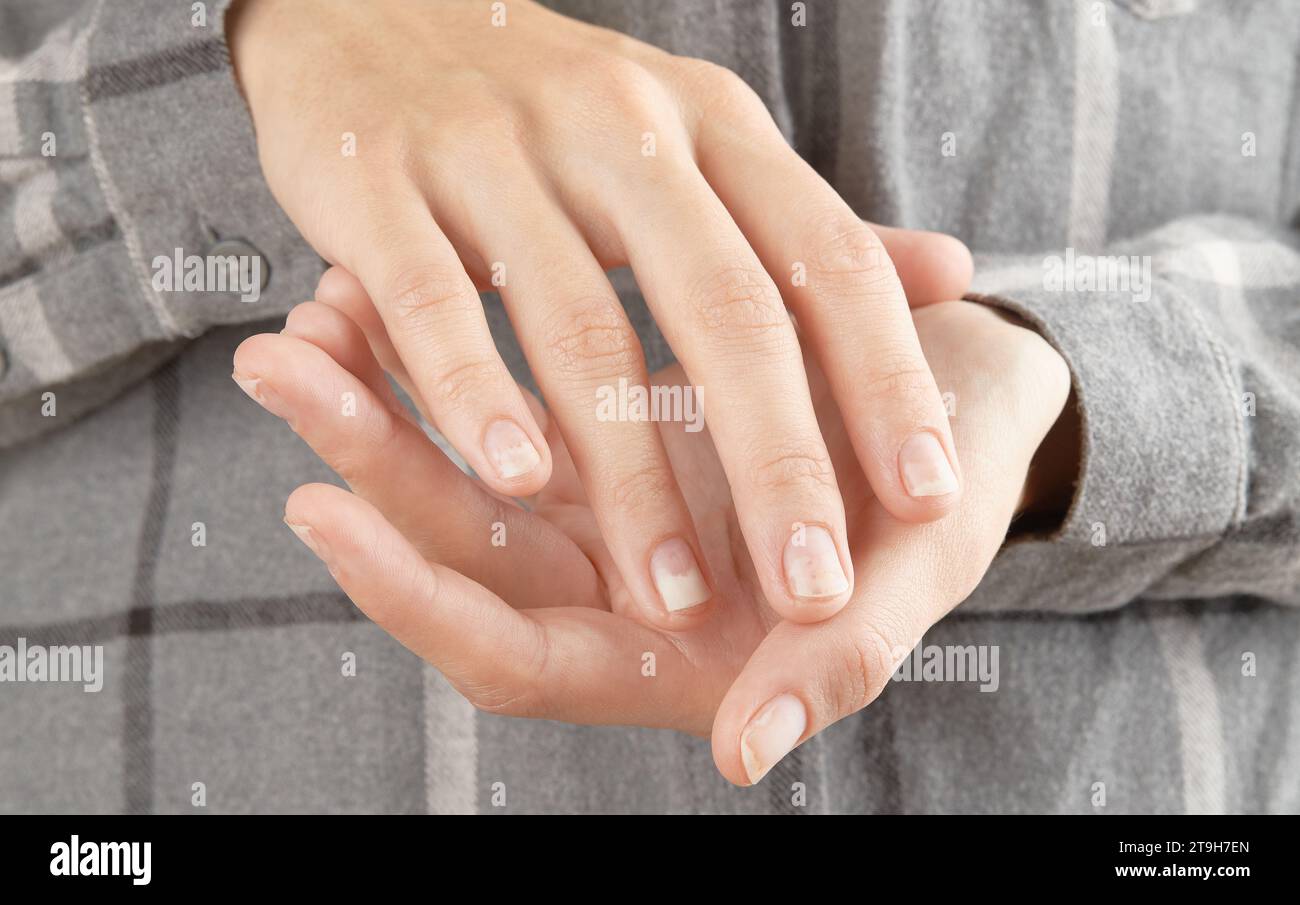 Fingernails with onycholysis after removing gel polish. Womans hands with damaged nails Stock Photo