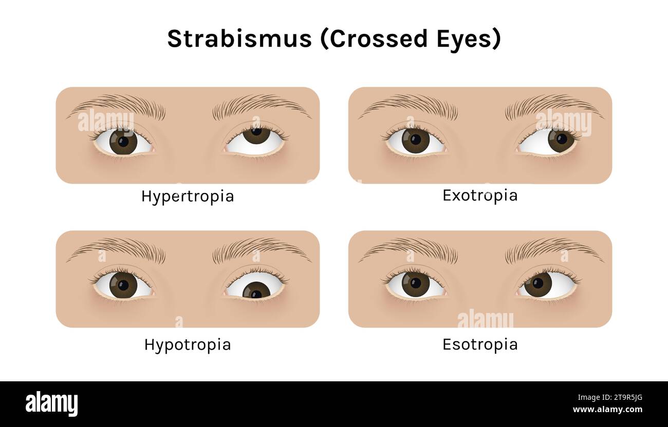 Realistic human eyes with strabismus vector illustration design. Stock Vector