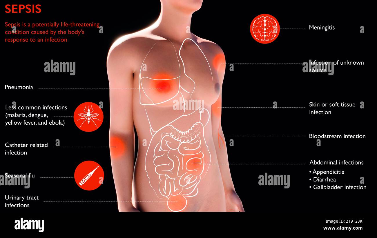 Sepsis is a potentially life-threatening condition caused by the body's 