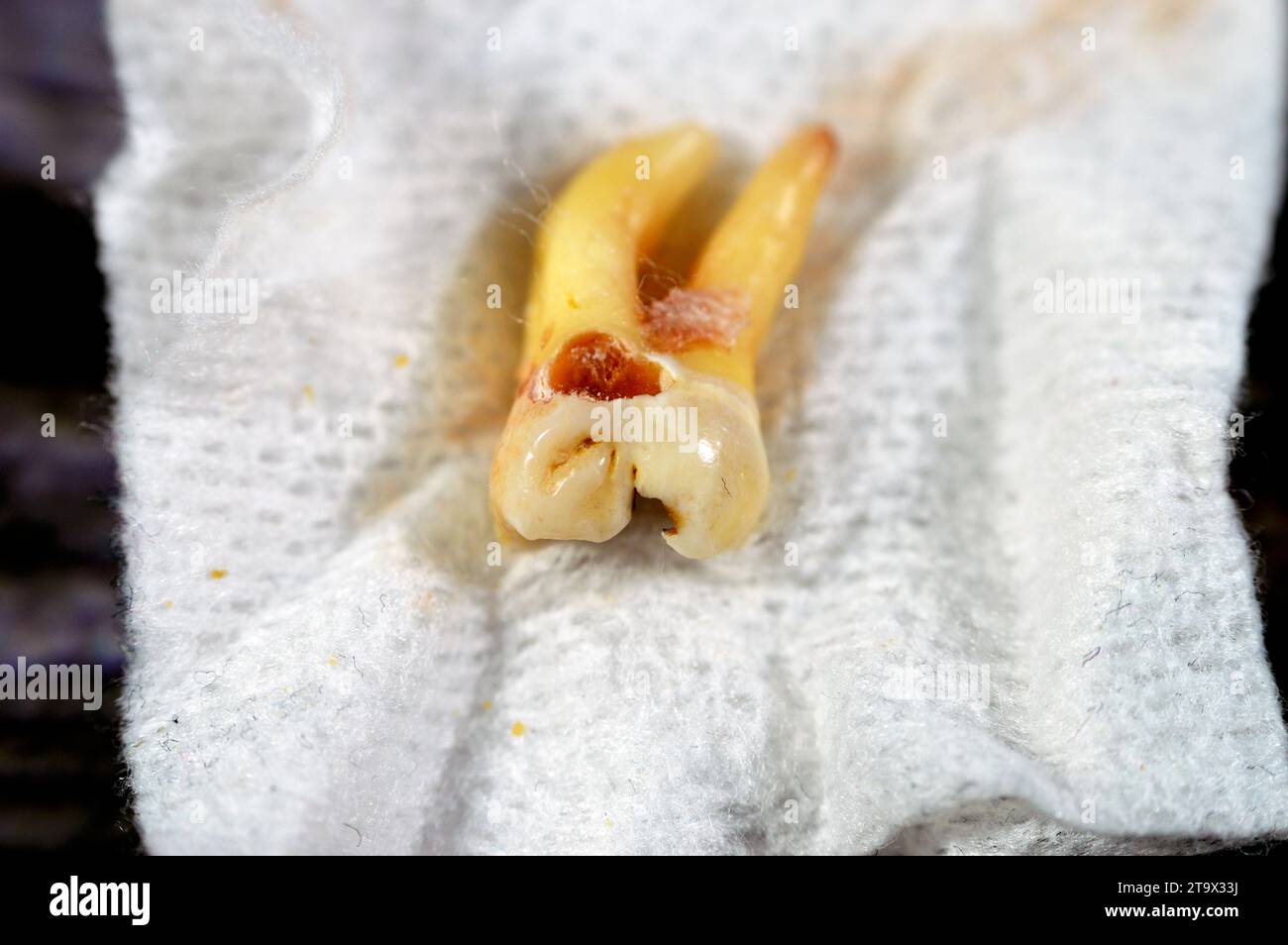 Extracted wisdom 8th lower right tooth with a teeth decay, after