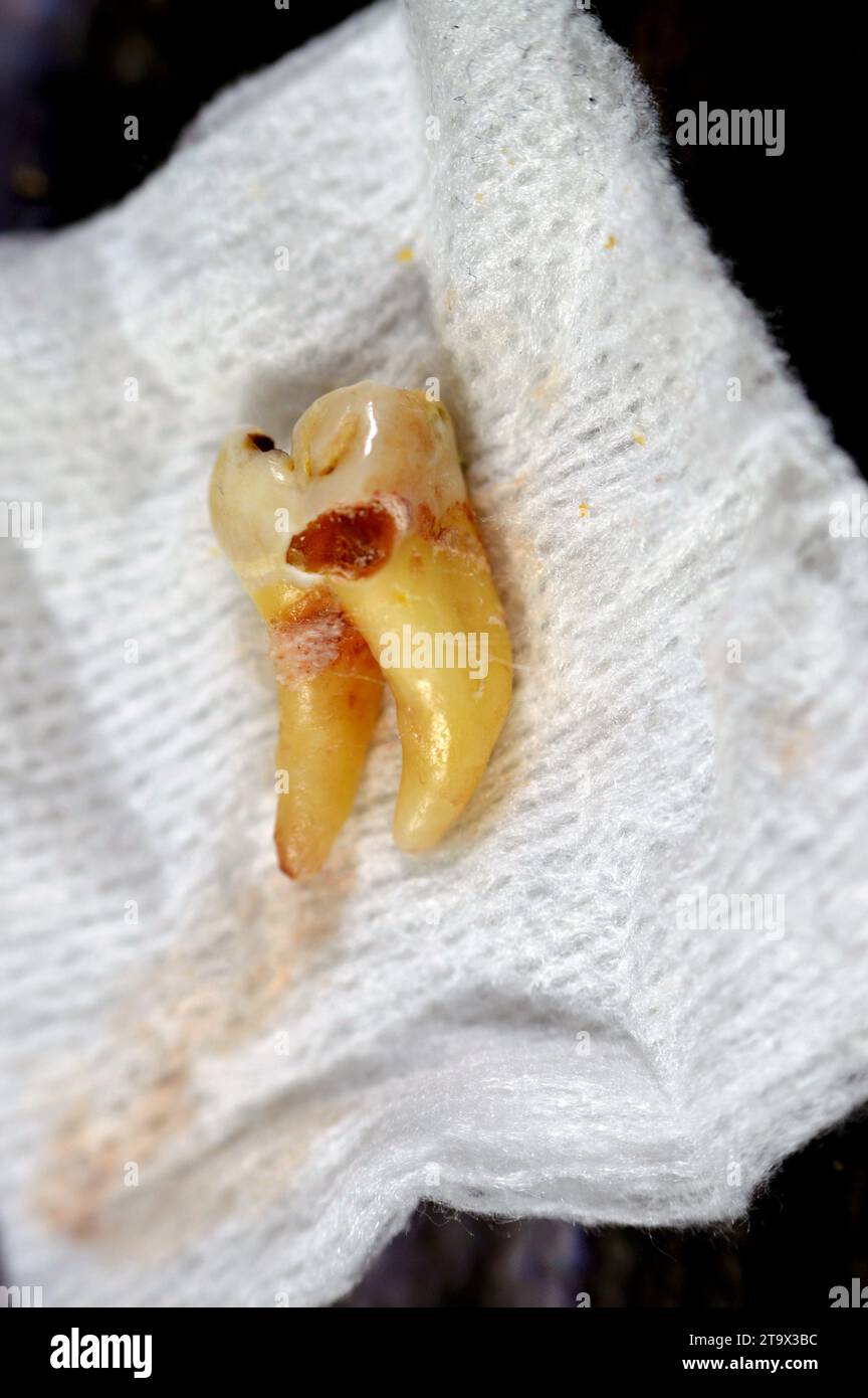 Extracted wisdom 8th lower right tooth with a teeth decay, after