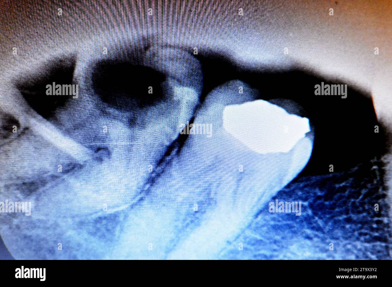X ray on wisdom 8th lower right tooth with a teeth decay, after exposed nerve and severe pain, swelling and inflammation, Wisdom teeth are the molars Stock Photo