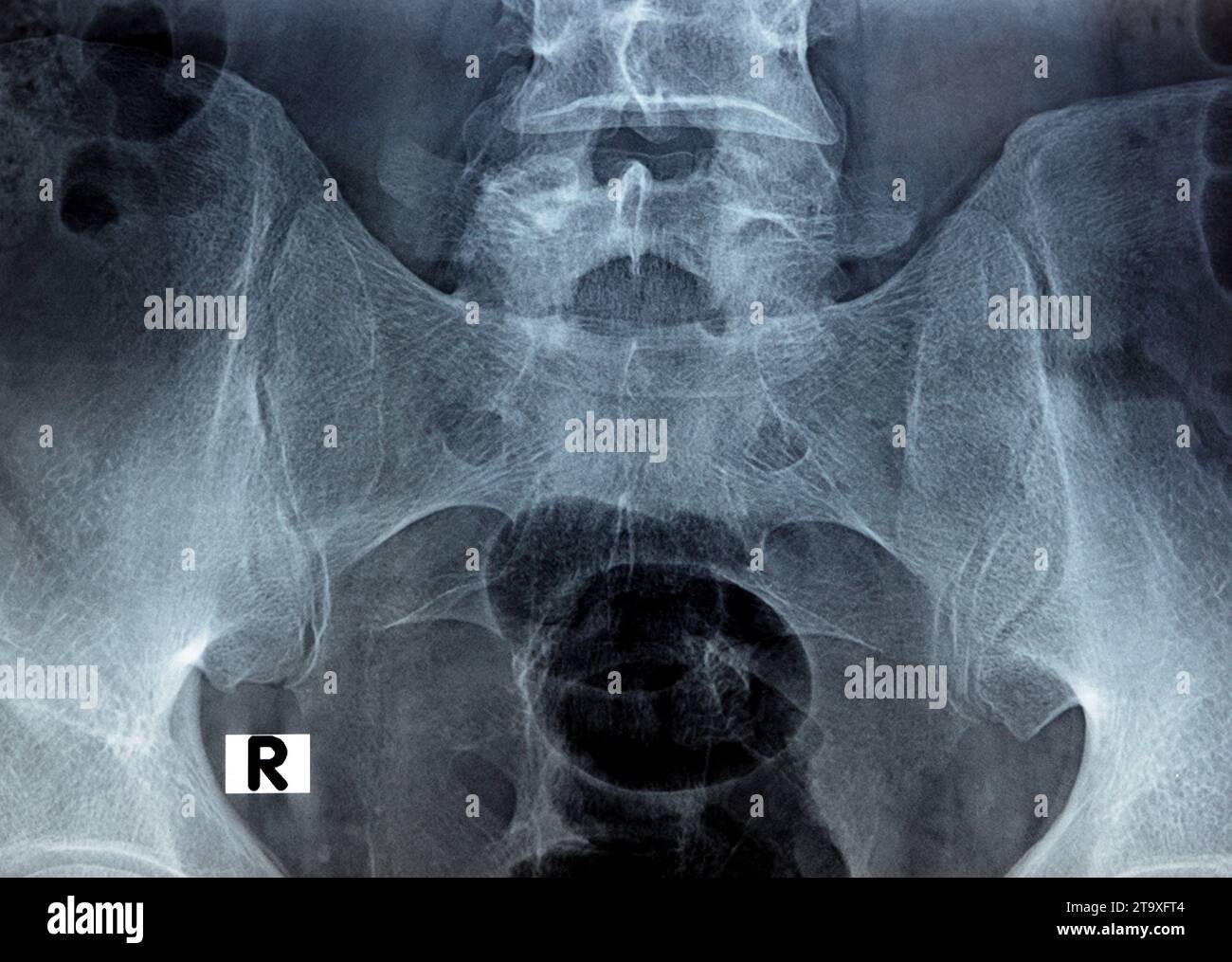 Sacroiliac joint digital radiograph examination X-ray reveals preserved ...