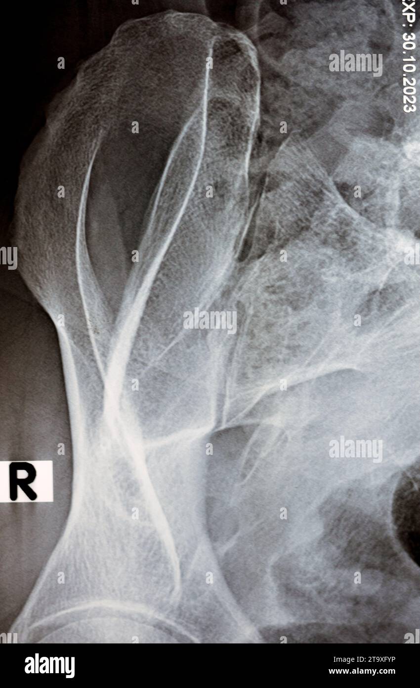 Sacroiliac joint digital radiograph examination Xray reveals preserved