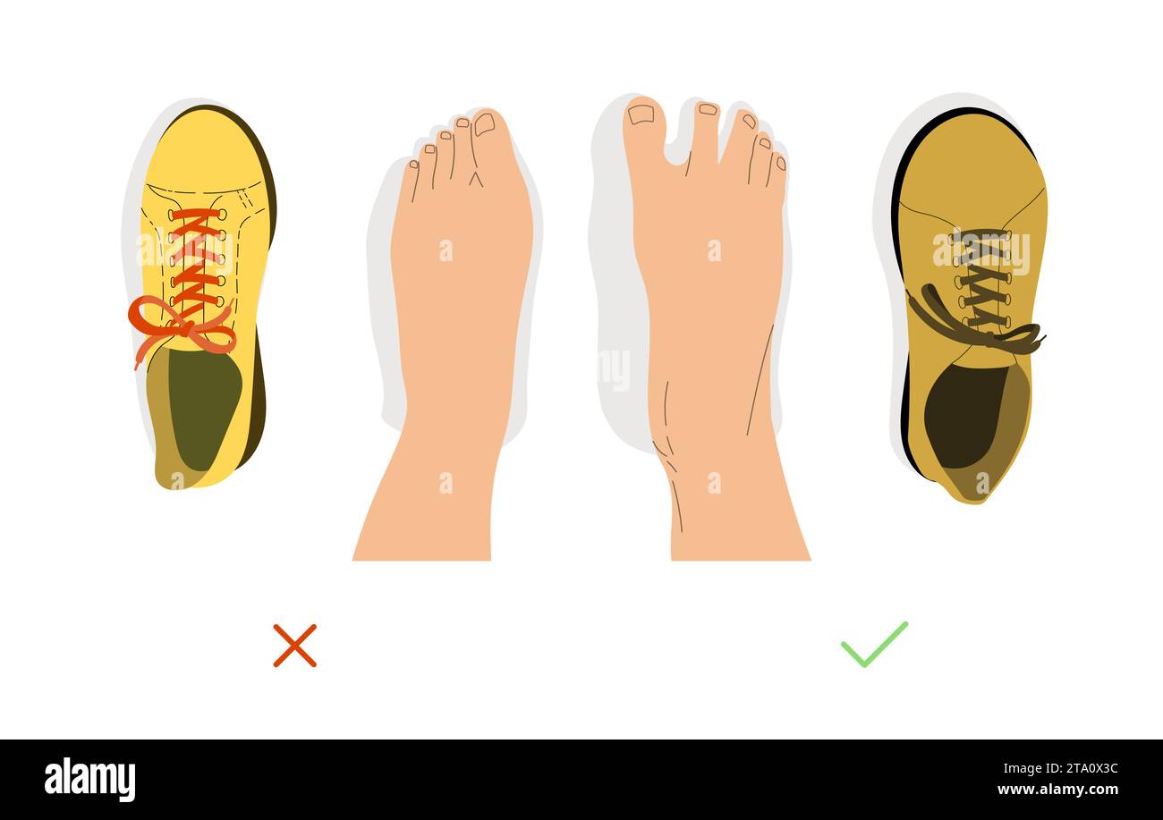 Top view comparison of healthy and deformed feet after wearing regular and barefoot shoes. Shoes