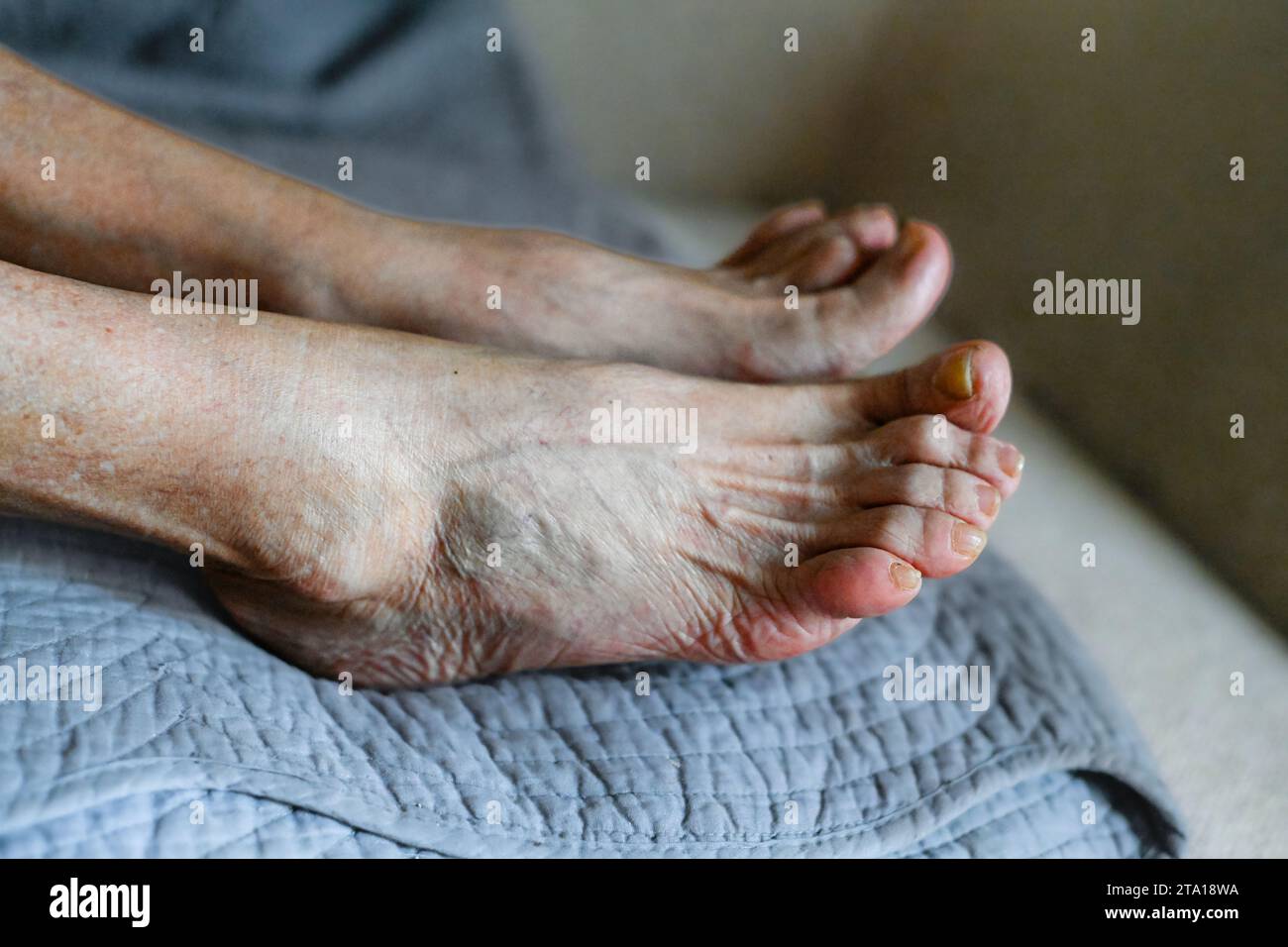 senior-woman-foot-with-medical-condition-ostheo-arthritis-inflammation