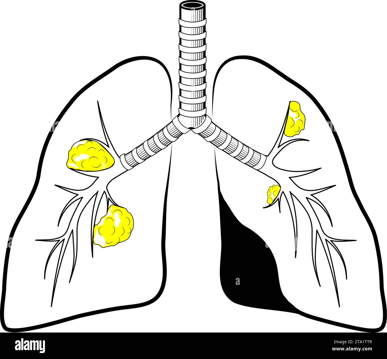 Human lungs with cancer. black line icon. Simple outline style. Stylized pictogram for web design, or mobile app. Vector illustration. flat line symbo Stock Vector