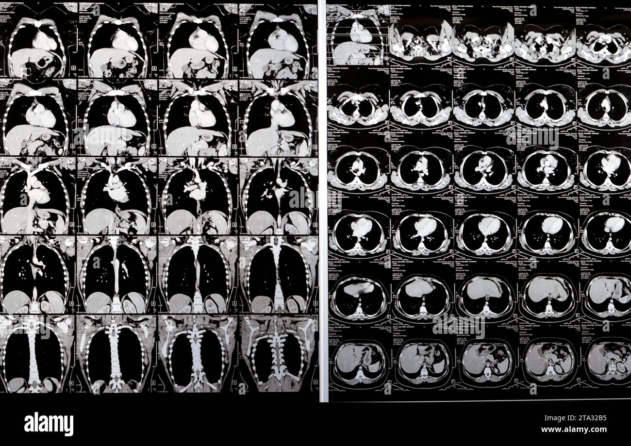 Cairo Egypt October 15 2023 Ct Scan Axial Slices Through Chest With Contrast Injection 7017