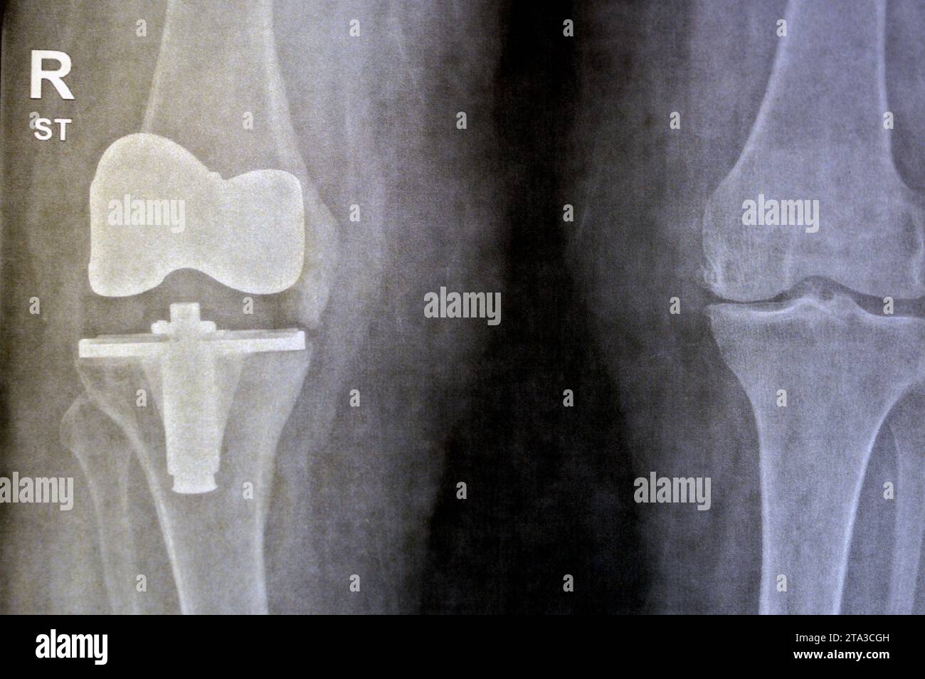 Plain Xray of knee joints, right side shows total knee replacement