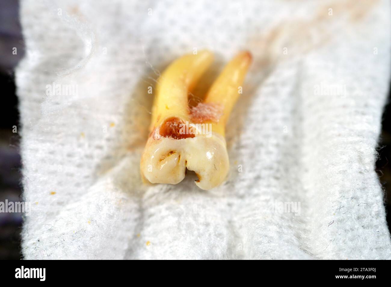Extracted wisdom 8th lower right tooth with a teeth decay, after exposed nerve and severe pain