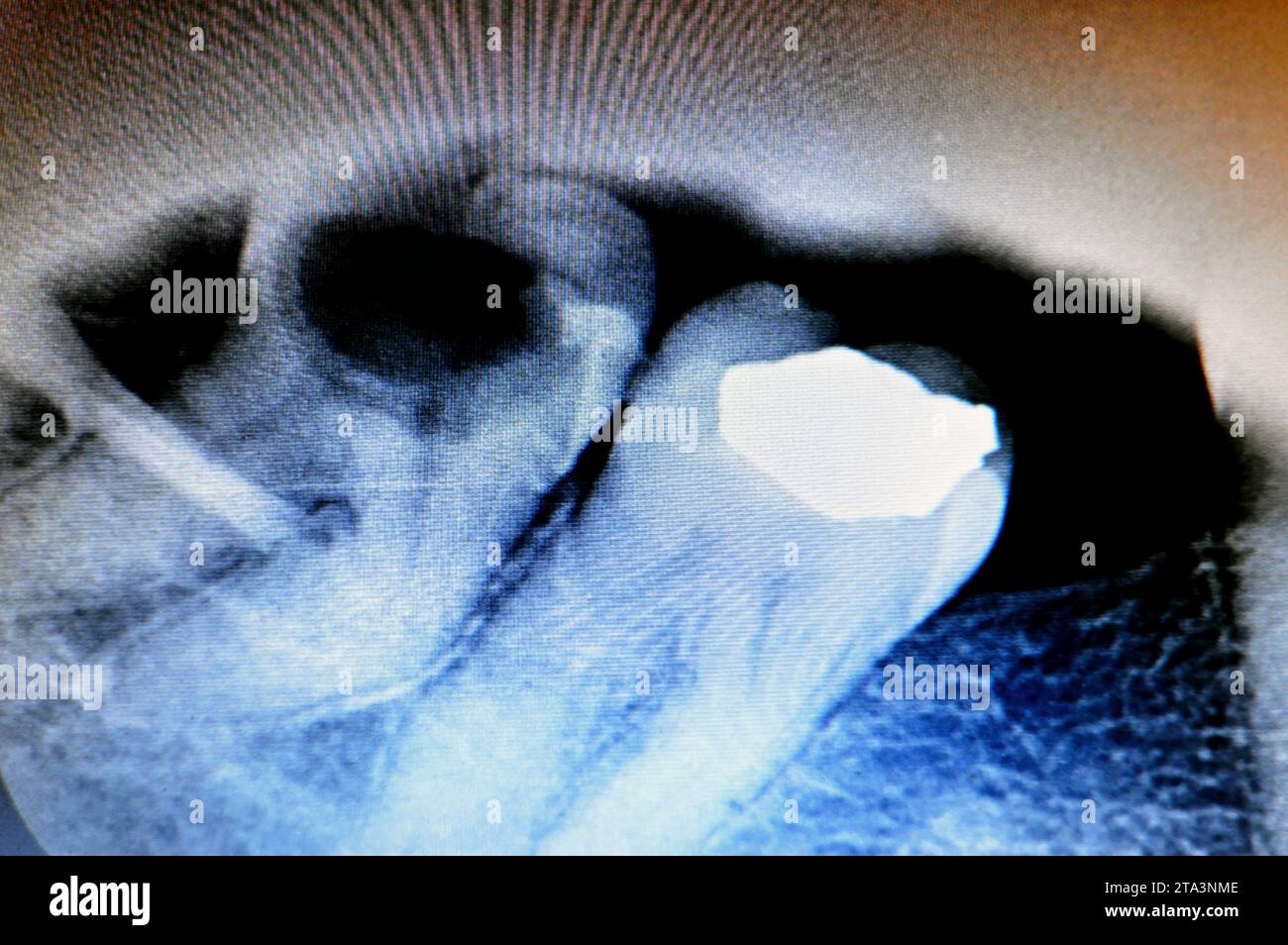 X ray on wisdom 8th lower right tooth with a teeth decay, after exposed