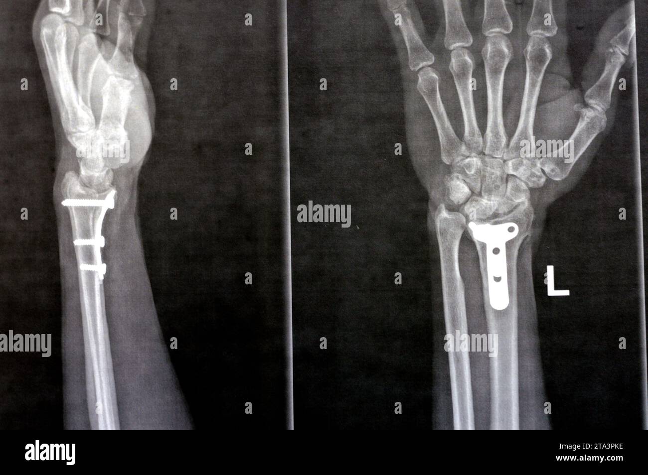 Plain x ray showing a recent fissure fracture at the lower part of a