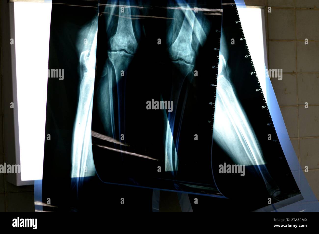 Plain X ray rolls of a medical case before total knee replacement operation, Knee joint osteoarthritis, with definite osteophytes and joint space narr Stock Photo