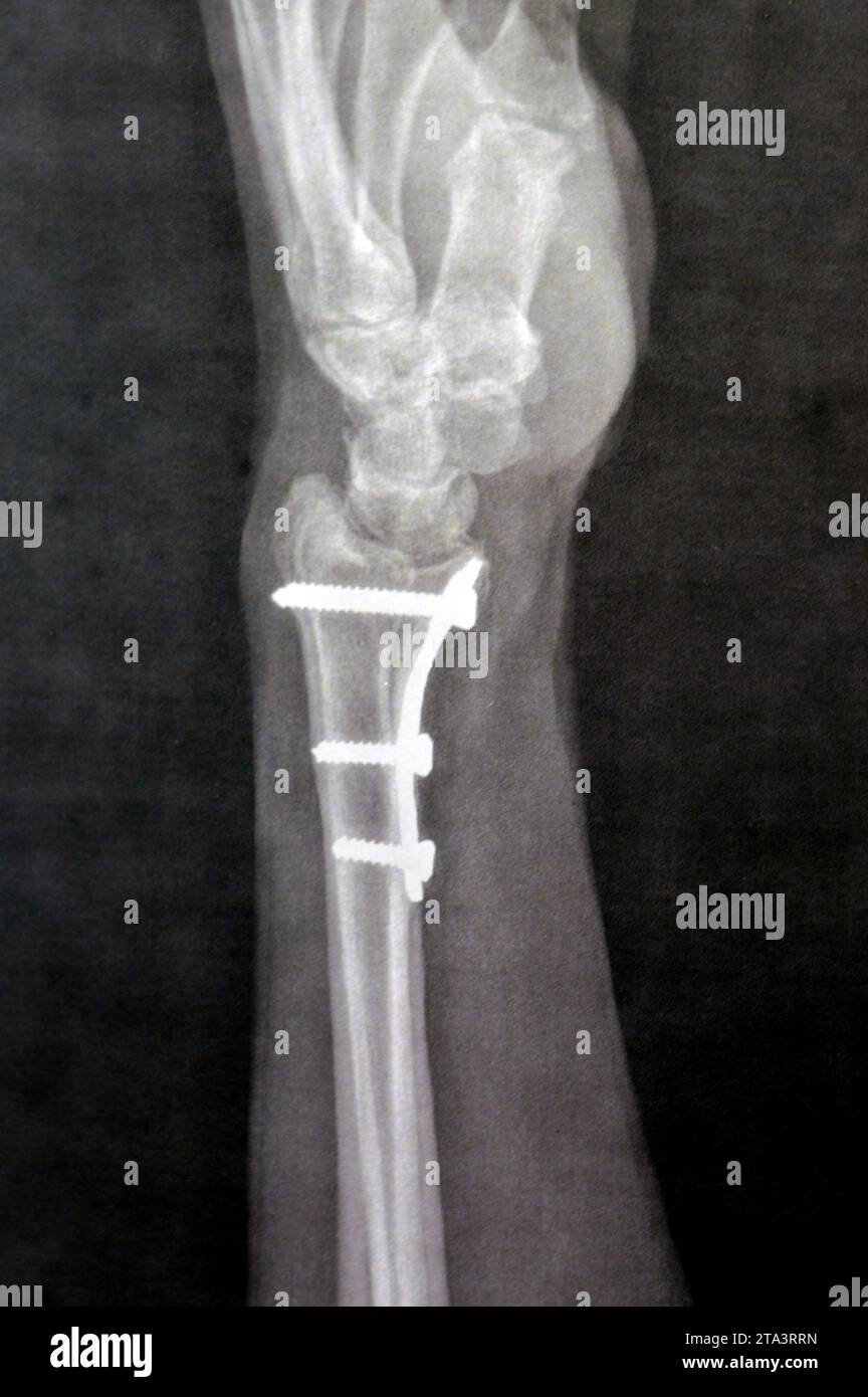 Plain x ray showing a recent fissure fracture at the lower part of a