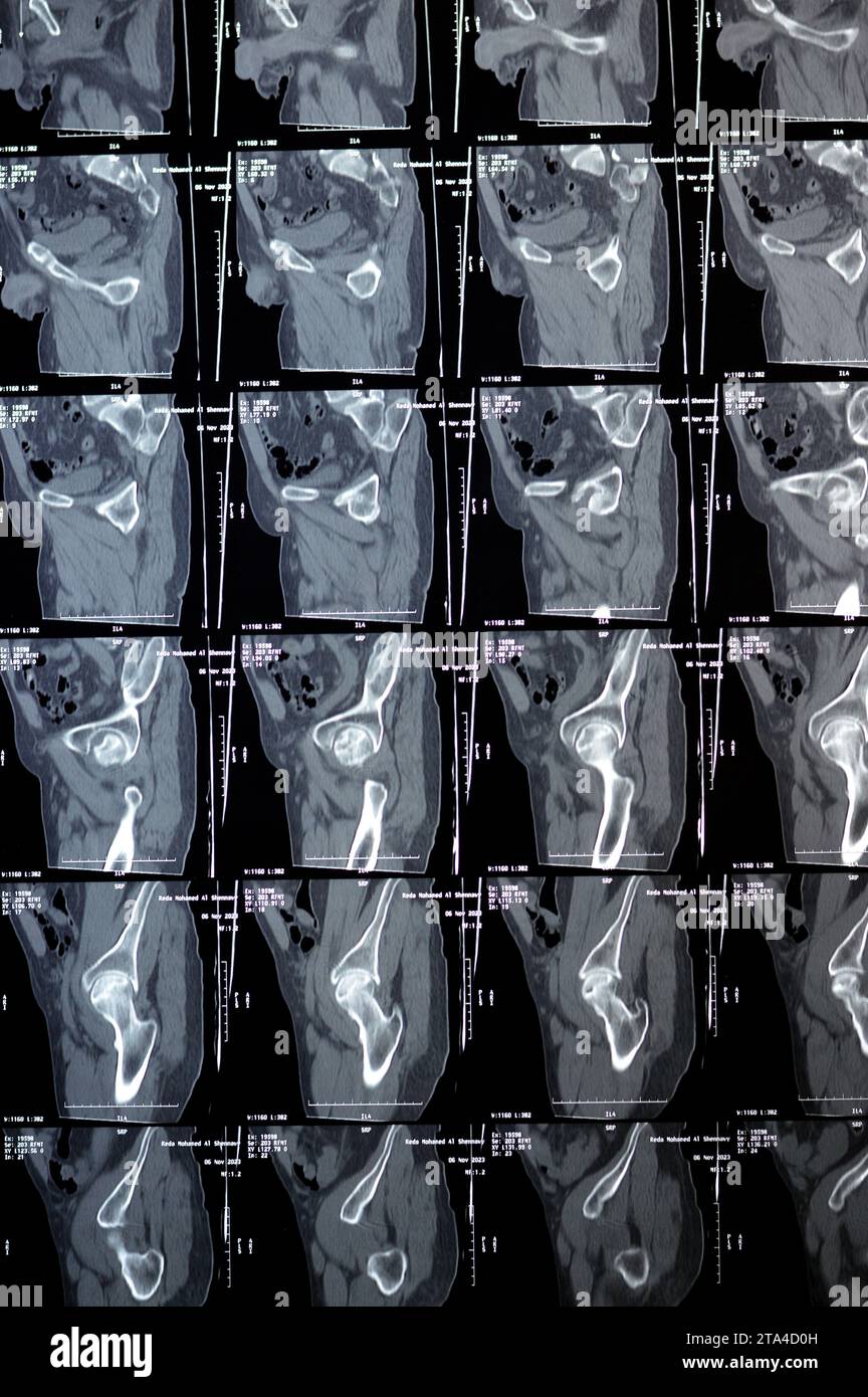 Cairo, Egypt, November 21 2023: non enhanced CT scan of the pelvis revealed grade I anterolisthesis of L4 and L5 lytic degenerative, normal urinary bl Stock Photo