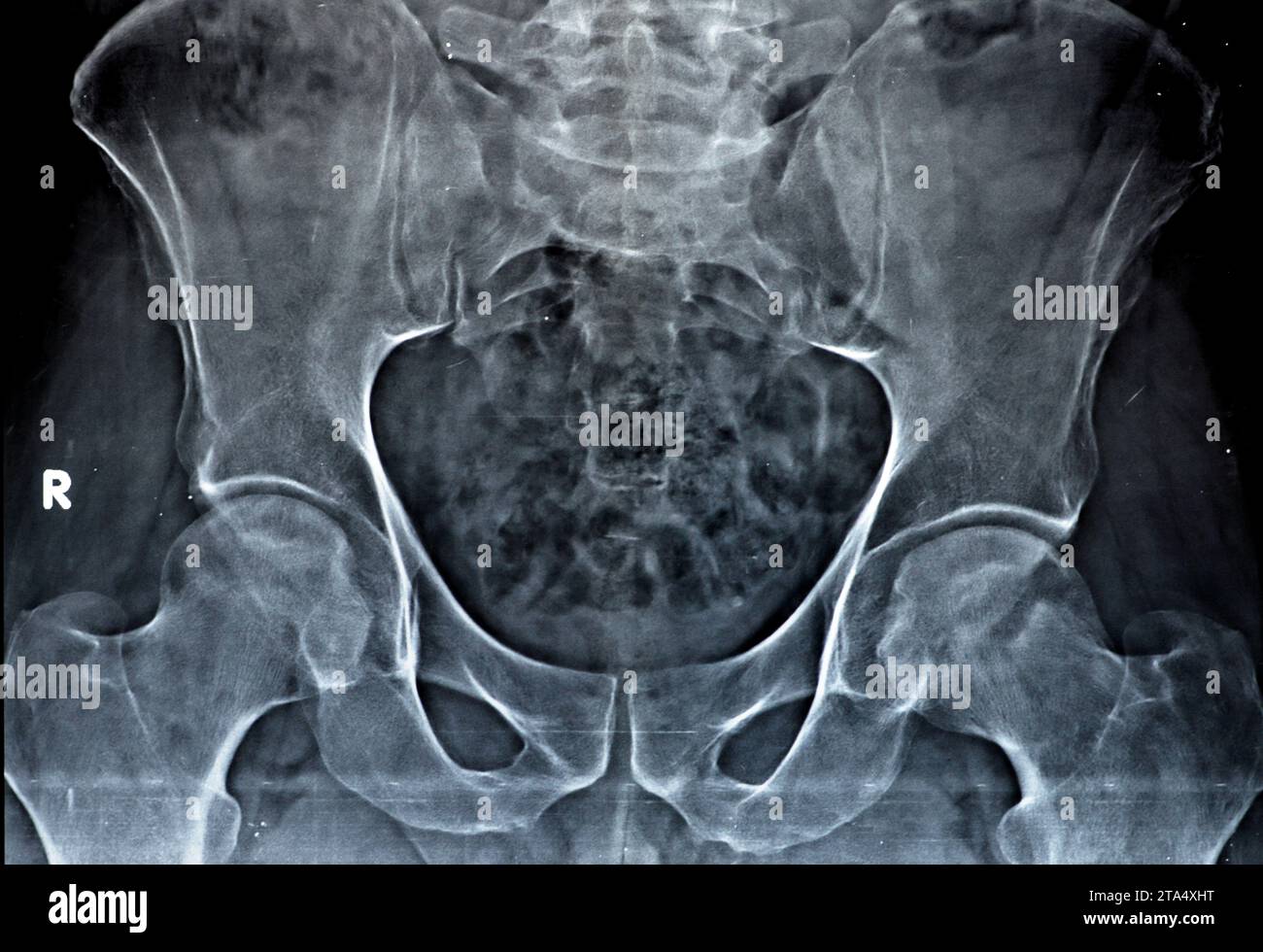 Plain X-ray of both hip joints revealed slight narrowing of superolateral aspect of both hip joints spaces with subchondral sclerosis of the opposed a Stock Photo