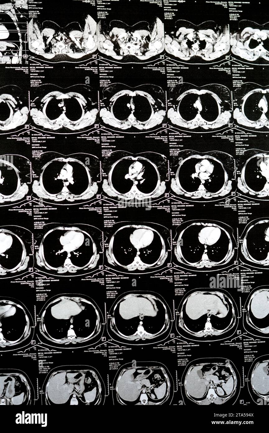 Cairo, Egypt, October 15 2023: CT scan axial slices through chest with contrast injection showing low grade of inflammatory reaction, parenchymal vess Stock Photo